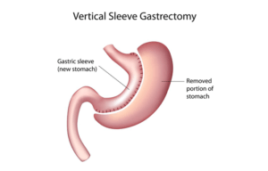 First Baptist Medical Center | Gastric Sleeve Surgery | Vertical Sleeve ...